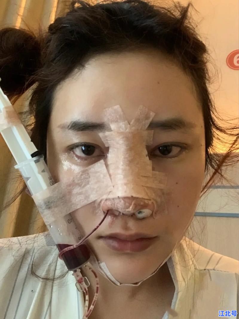 朱刚强鼻子做得怎么样？2024真人案例全记录 高清术前术后对比图揭秘鼻尖塑形效果